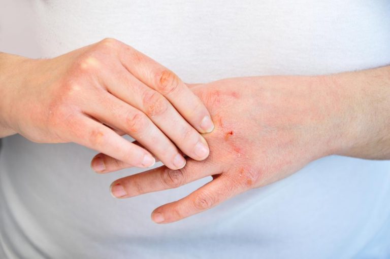 5 Useful Tips for Psoriasis Treatment